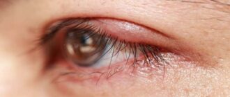 Лучшие глазные капли от ячменя – успешно боремся с воспалением глаз